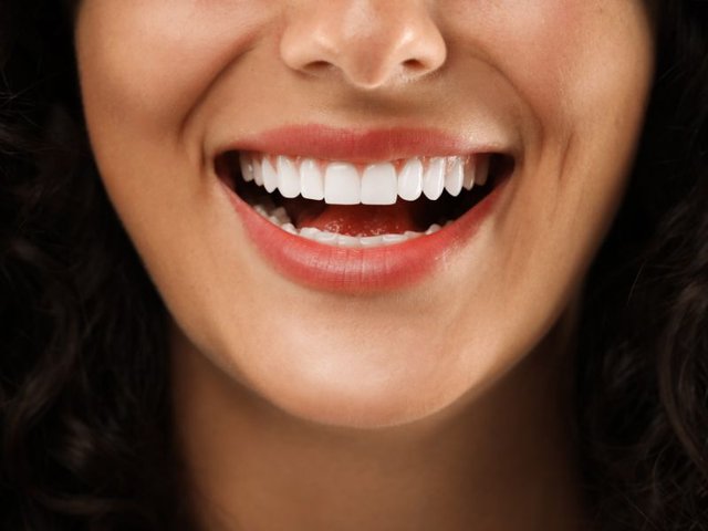 Comparação de dentes representando dúvidas sobre o preço da lente de contato dental em Brasília