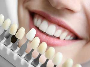 Paciente em avaliação para clareamento dentário em Brasília